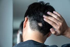 Alopecia Hair Transplant in Raipur
