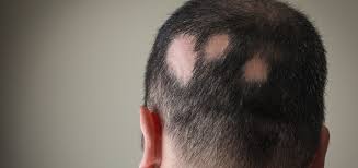 Alopecia Treatment in India