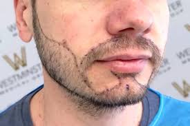 Beard Transplant in Raipur