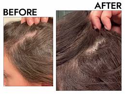 Best Hair Regrowth in Raipur