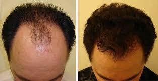 Best Hair Restoration Technique in Raipur