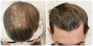 Best Hair Transplant Near Me in Raipur