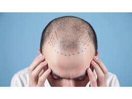 Best cost hair transplant in Raipur