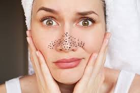 Blackheads Removal Treatment in Raipur