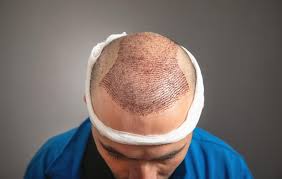 Call Hair Transplant Expert in Raipur