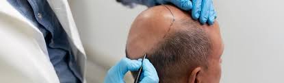 Cheap Hair Transplant in Raipur