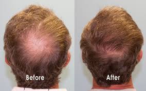 Crown Hair Transplant in Raipur