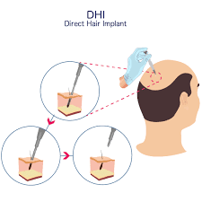 DHI Scalp Treatment in Raipur
