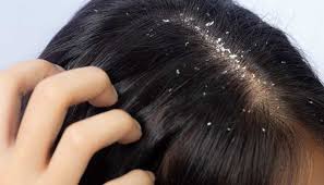 Dandruff Treatment Near Me in Raipur