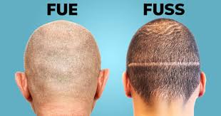 FUE Scalp Treatment in Raipur