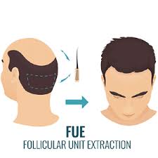 FUE Hair Transplant in Raipur