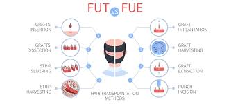 FUE vs FUT Comparison in Raipur
