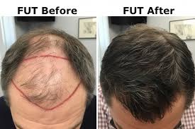 FUT before after results in Raipur