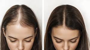 Female Hair Loss Treatment in Raipur