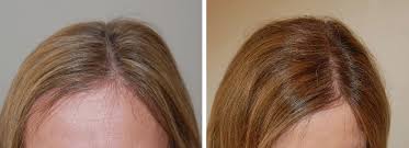 Female Hair Transplant in Raipur