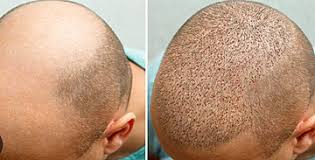 Free Hair Transplant Consultation in Raipur