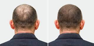 Hair Fall After Hair Transplant in Raipur