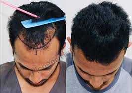 Hair Graft Clinic Near Me in Raipur