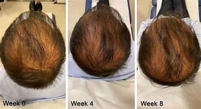 Hair Loss Treatment in Raipur
