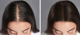 Hair Restoration in Raipur