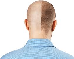 Hair Specialist Near Me in Raipur