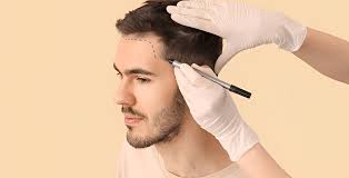 Hair Transplant Appointment in Raipur