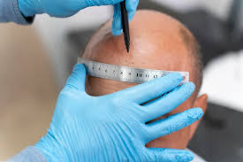 Hair Transplant Charges in Raipur