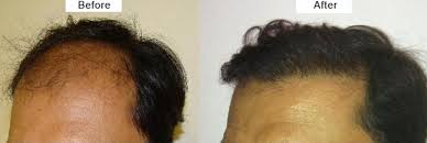Hair Transplant Cost Per Graft in Raipur
