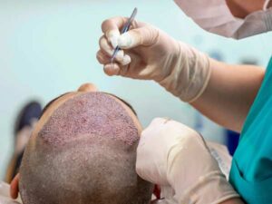 Scalp Treatment in Raipur