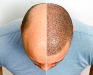 Hair Transplant Doctor in Raipur