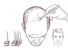 Hair Transplant FAQs in Raipur