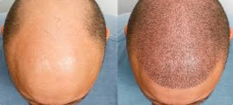 Hair Transplant In Raipur