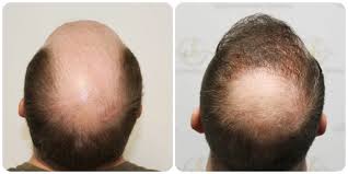 Hair Transplant Near Me in Raipur