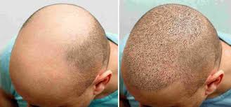 Hair Transplant Packages in Raipur