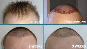 Hair Transplant Recovery Time in Raipur
