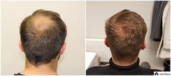 Hair Transplant Results Pictures in Raipur