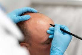 Hair Transplant Results in Raipur