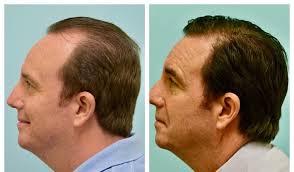 Hair Transplant Reviews in Raipur