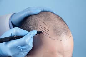 Hair Transplant Specialist in Raipur