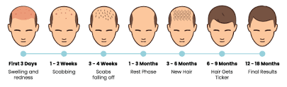 Hair Transplant Timeline in Raipur