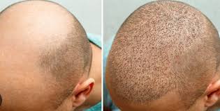 Hair transplant and hair regrowth in Raipur