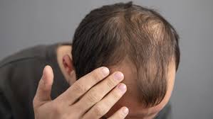 Hair loss doctor in Raipur