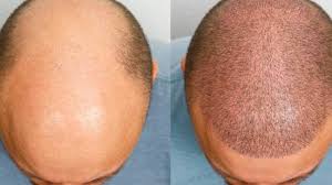 Hair transplant near Raipur
