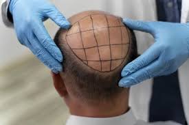Hair transplant rates in Raipur