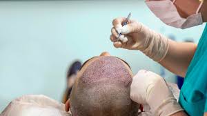Hair transplant surgeon near me in Raipur