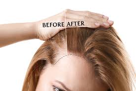 How Hair Transplant Works in Raipur