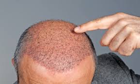 How Much Hair Transplant Costs in Raipur