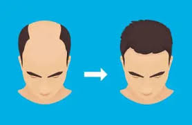 How Much is Hair Transplant in Raipur