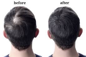 How to Regrow Hair at Home in Raipur