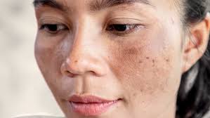 Hyperpigmentation Solutions in Raipur